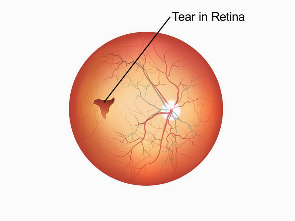 Retinal Detachment: Symptoms & Causes