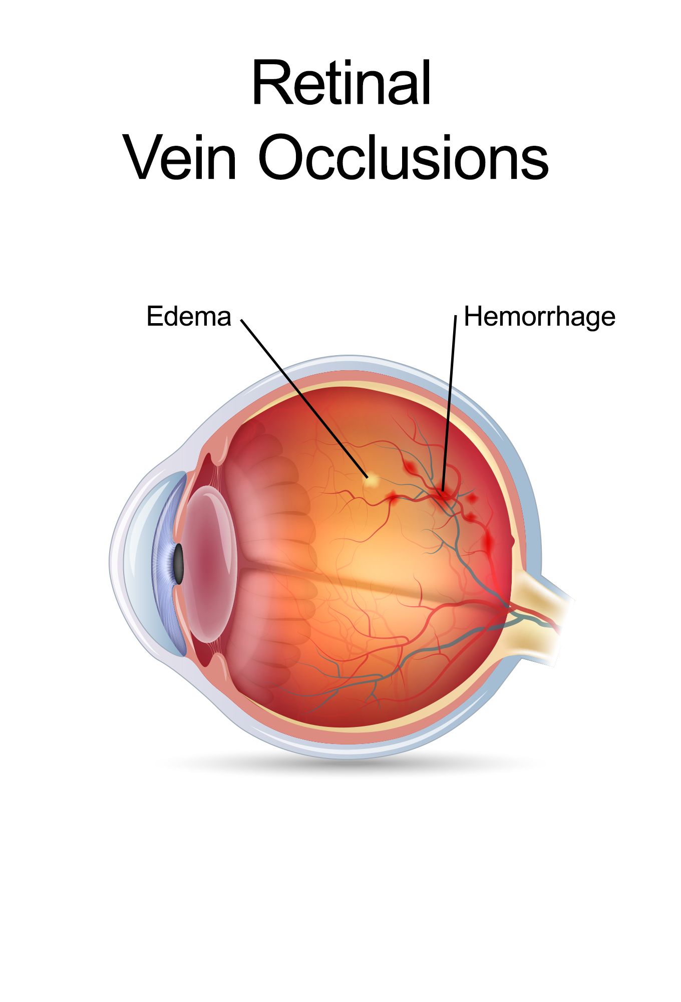 How to Improve the Health of the Retina?