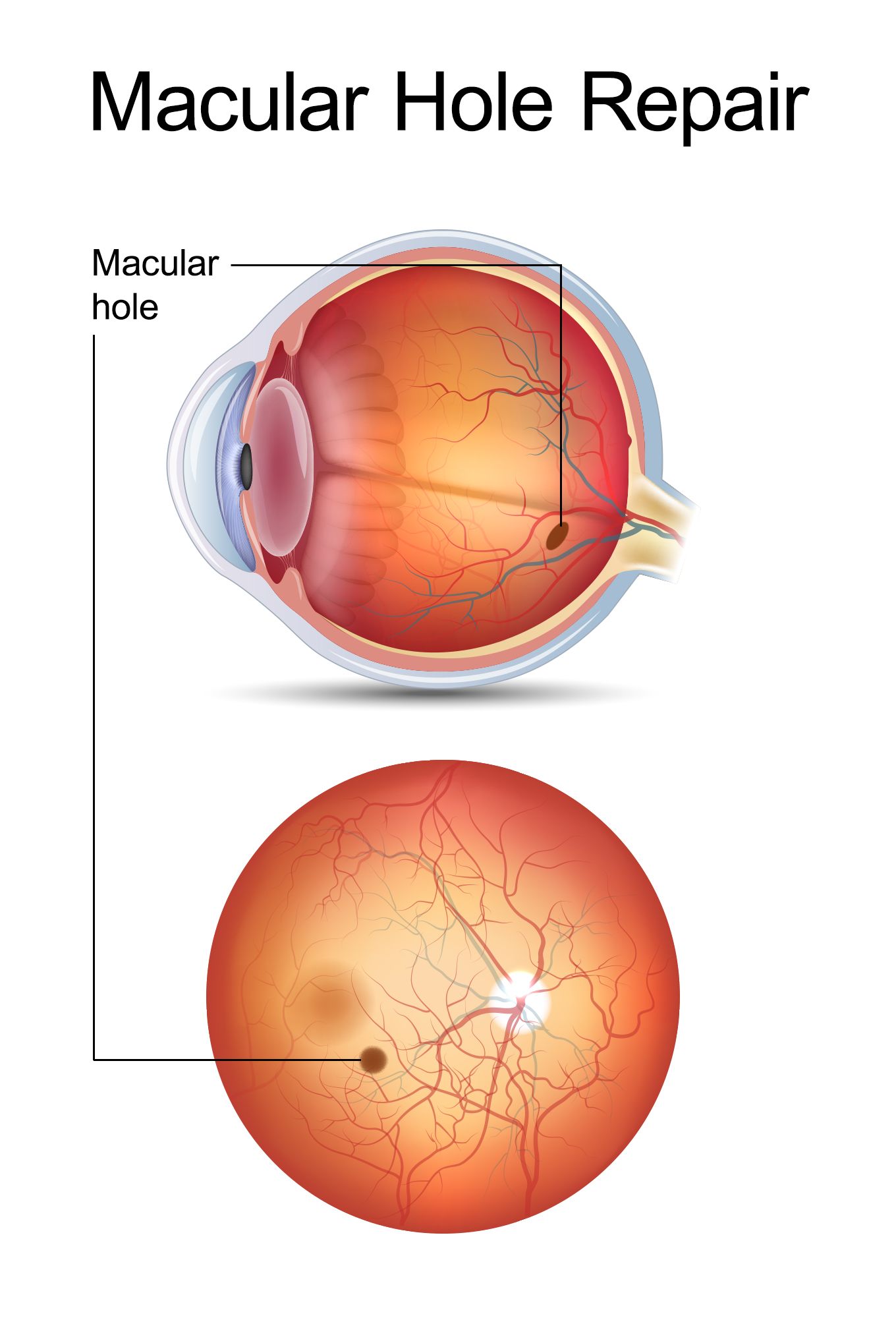 Macular Holes: How They Are Caused and Treated