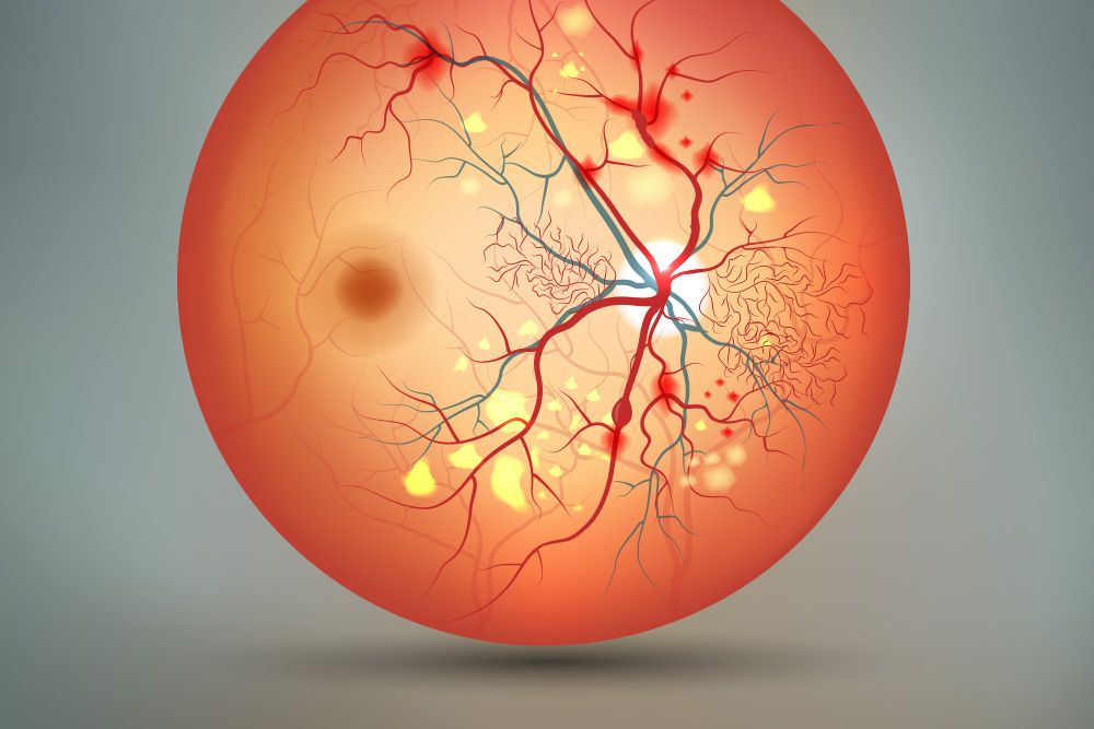 Types of Retinal Vascular Disorders | Retina Associates Kansas City