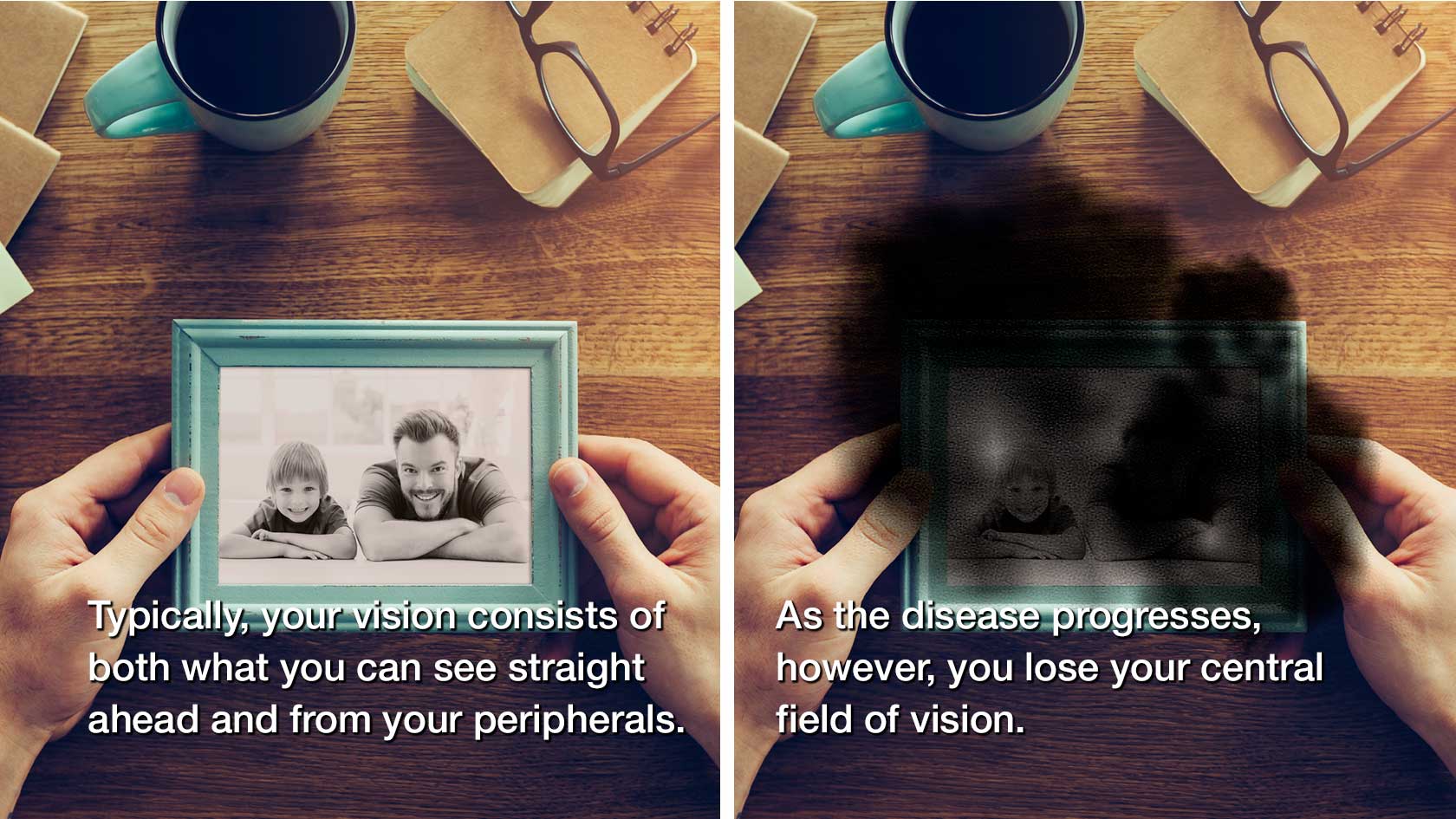 Age-Related Macular Degeneration / AMD